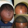 Hair Transplant Before and After: What to Expect and How It Works