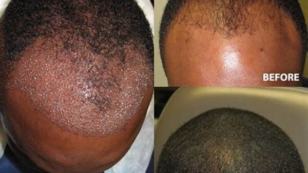 Hair Transplant Before and After: What to Expect and How It Works